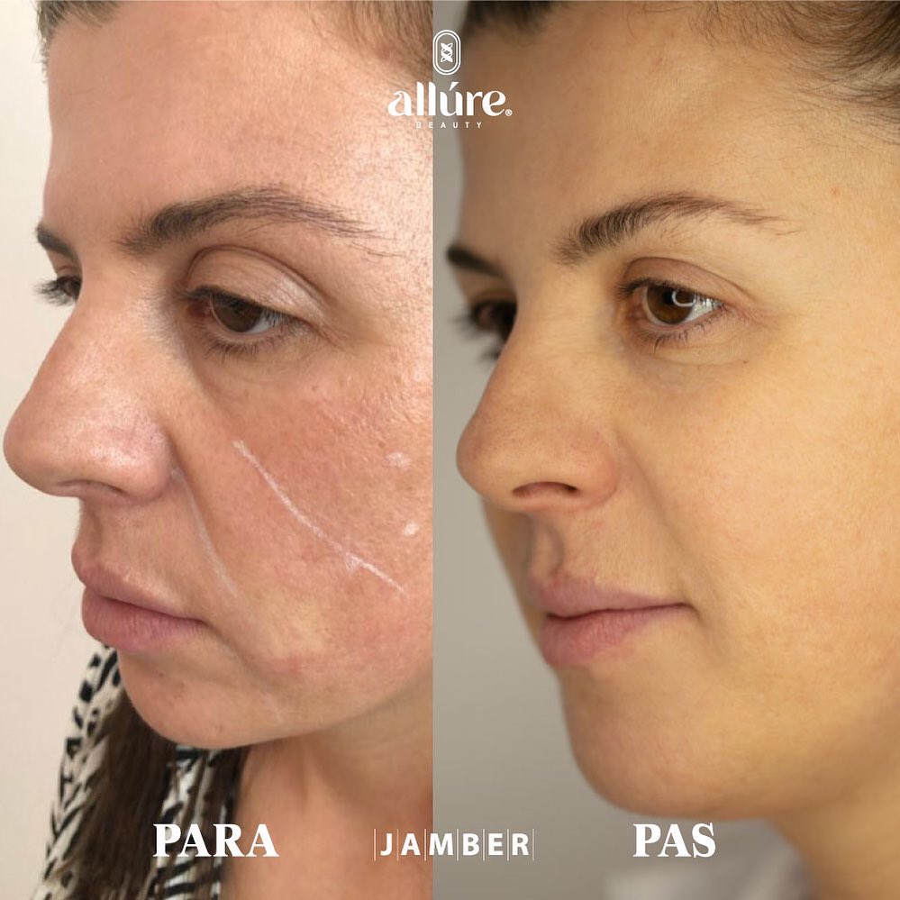 Jamber before and after result, case 26