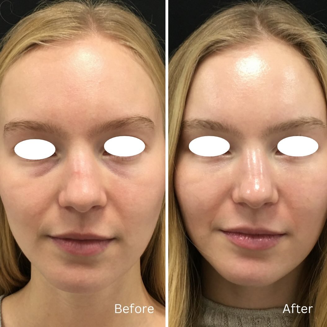 Jamber before and after result, case 16